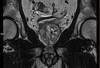 Imagerie uro-génitale - IRM de la prostate