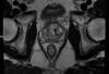 Imagerie uro-génitale - IRM de la prostate