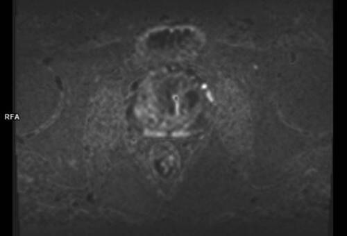 Imagerie uro-génitale - IRM de la prostate