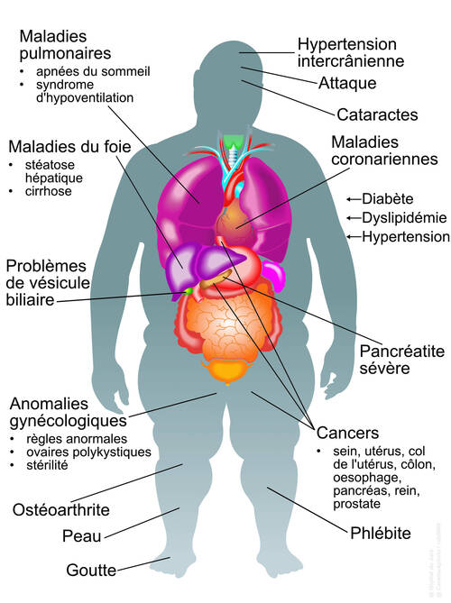 obésité complications